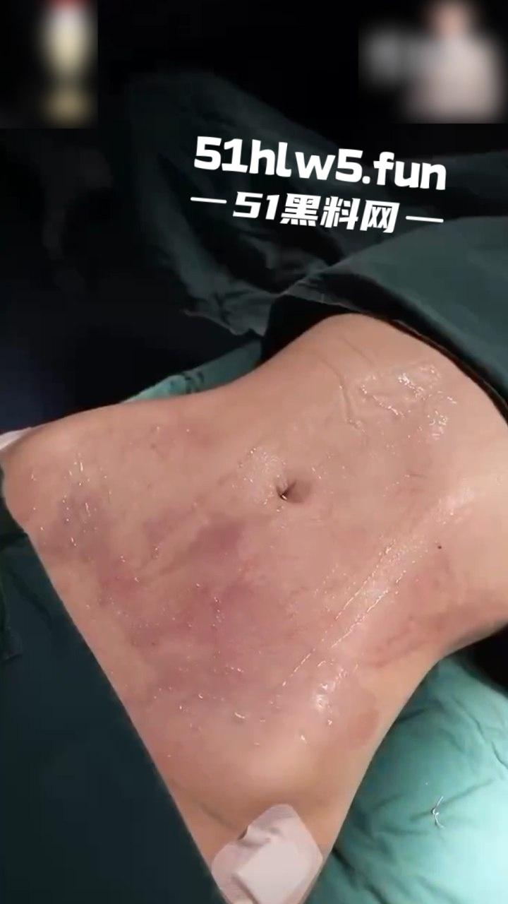 实拍整形医院，小仙女整容抽脂和填充全过程，看着残忍但做完后惊艳的效果让人震撼。-5